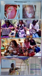 Le Dr Mbou Essié Darius Eryx, gynécologue-obstétricien et spécialiste de santé publique alerte sur l’augmentation préoccupante des cas de cancer, notamment celui du col de l’utérus, devenu un défi majeur pour les systèmes de santé locaux.